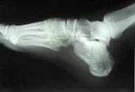 ankle bone
